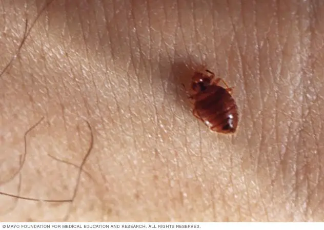 What Can You Eat to Keep Bed Bugs From Biting You?