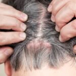 Can Head Lice Hurt You?