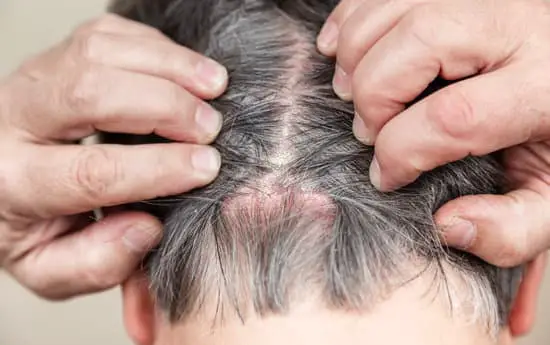 Can Head Lice Make Your Body Itch?