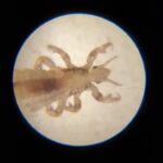 Why Do Head Lice Make You Itch?