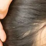 Why Are Head Lice So Itchy?