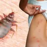 How Are Bed Bugs Treated?