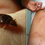 Do Bed Bugs Give You Pimples?